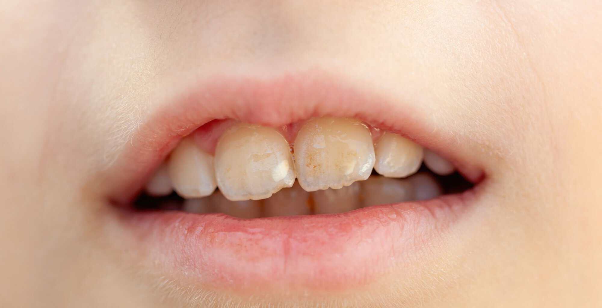 Causes of dental erosion, Tooth enamel erosion factors, Acidic foods and dental erosion, Plaque buildup and dental erosion, Poor oral hygiene causing enamel erosion, Bruxism and dental erosion, Impact of soda on dental erosion, Teeth grinding and enamel wear, Acid reflux leading to dental erosion, Environmental factors in dental erosion, How sugary drinks cause dental erosion, Dental erosion from frequent snacking, The role of stomach acid in tooth erosion, Preventing dental erosion, Dental erosion from improper brushing techniques, dental erosion causes